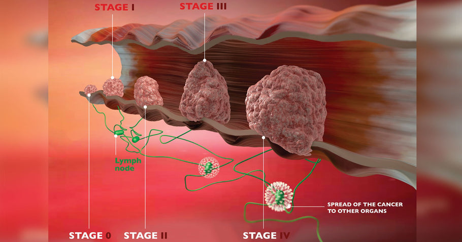 Astaxanthin/ValAsta suppresses the metastasis of colon cancer