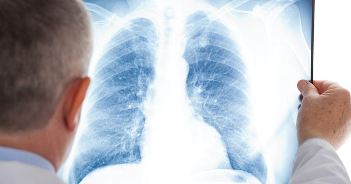 Lung cancer isn’t just for Smokers anymore.